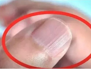 午夜成人福利电影廠家分析手指甲有豎紋的根本原因 午夜成人福利电影廠家分析手指甲有豎紋的根本原因